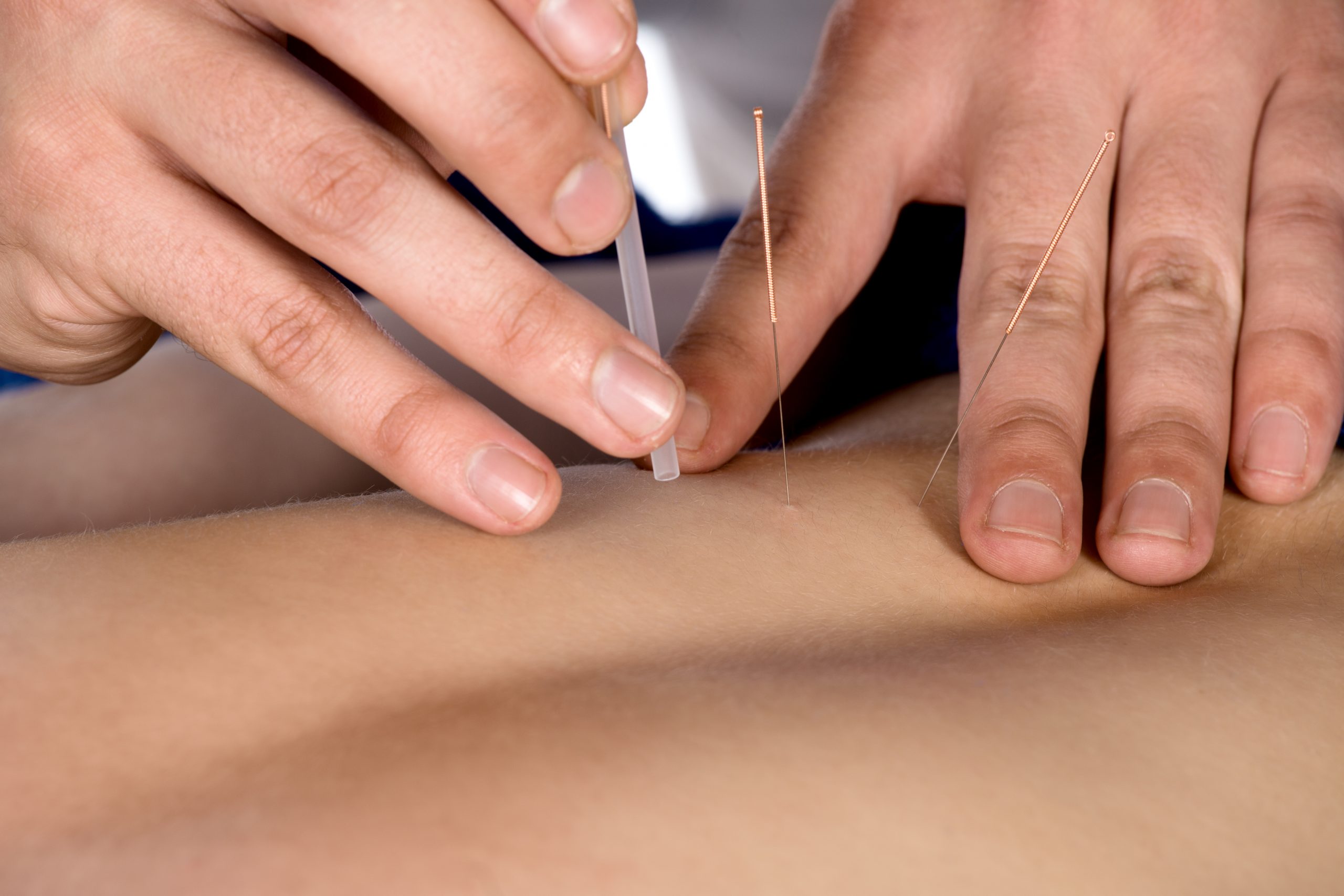 Image 10: Acupuncture